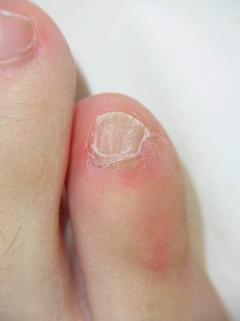 足小指の爪の痛み 内反小趾と爪変形 その2 治療編 神楽坂肌と爪のクリニック